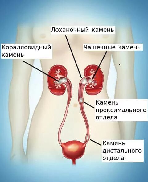 Куда сдать камень на анализ. Плотность камней в почках. Плотность камня в почке таблица кт. Куда сдать камень на анализ. Кристальна моча.