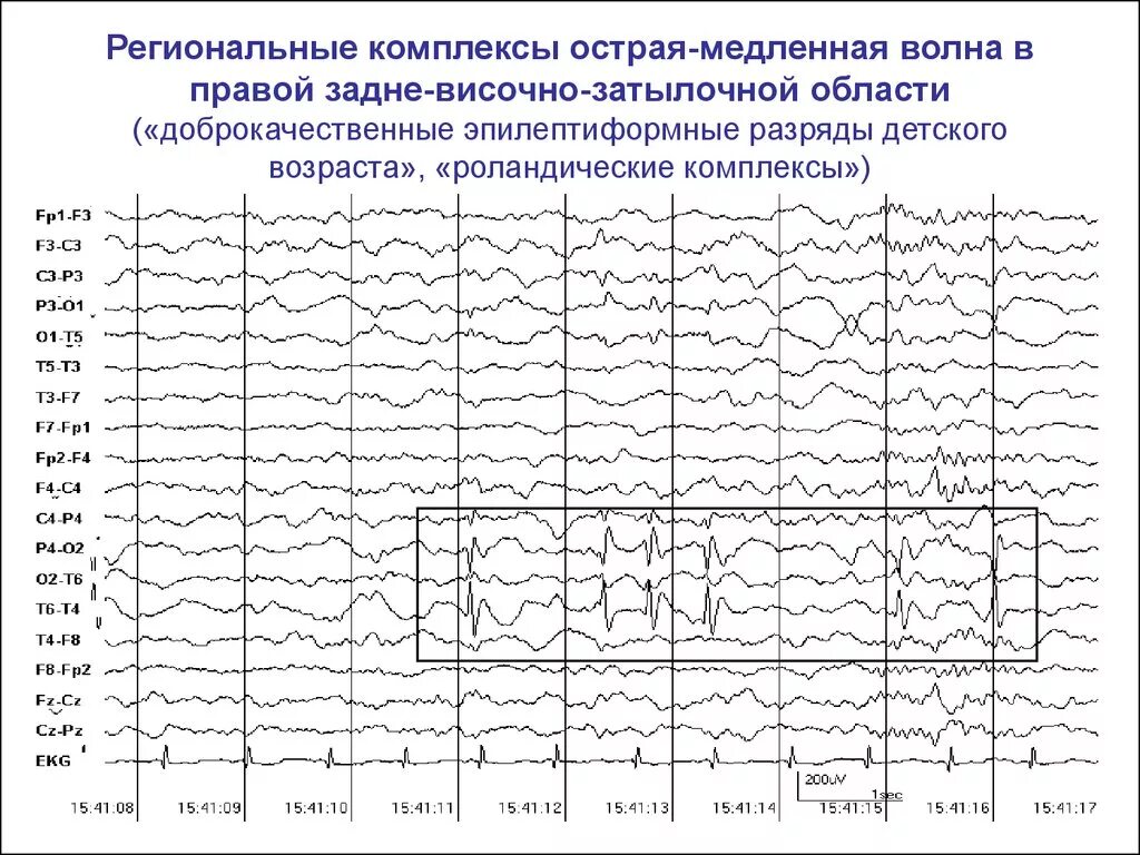 Роландическая эпилепсия ЭЭГ. Генерализованная эпилептиформная активность на ЭЭГ У ребенка. Доброкачественная роландическая эпилепсия на ЭЭГ. ЭЭГ волны при эпилепсии. Пароксизмальная активность мозга