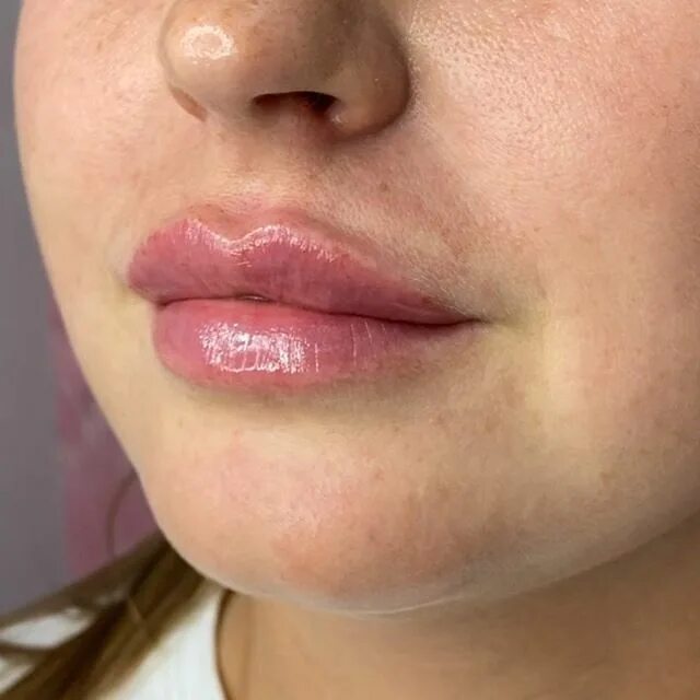 увлажнение губ гиалуроновой кислотой 0. губы после контурной пластики. увеличенные губы красивые. косметолог губы спб. контурная пластика губ до и после.