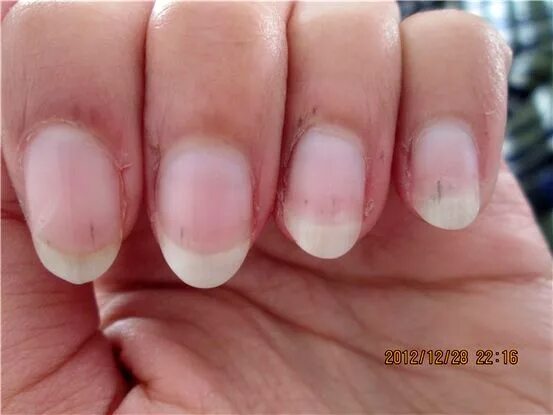 Lápiz de tratamiento de uñas antihongos, 100% hierbas naturales para las uñas de