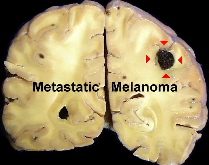 Меланома метастазы в мозг