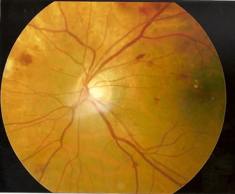 Ou гипертоническая ангиопатия сетчатки. Гипертоническая ретинопатия глазное дно. Вартикозная Вена сетчатки. Диабетическая ретинопатия.