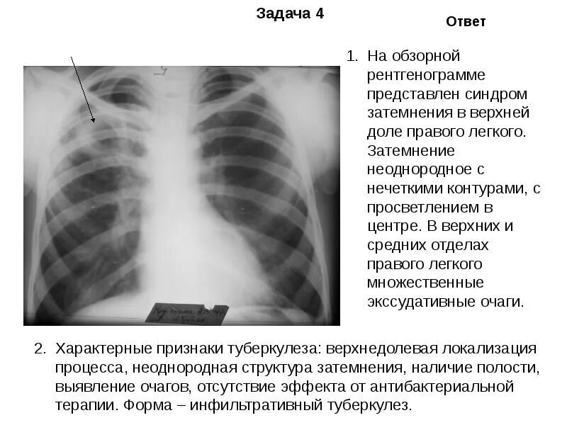 Затемнение легочной ткани на рентгене. Затемнение нижней доли легкого. Рентген тотальное затемнение легкого. Затемнение левого легкого на рентгене. Затемнение правого легкого что это.