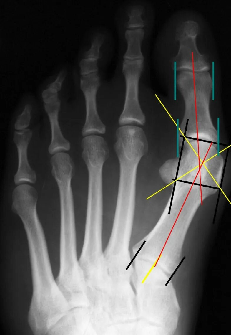 Халюс вальгус степени на рентгене. Hallux valgus степени рентген. Hallux valgus 4 степени рентген. Hallux valgus что это