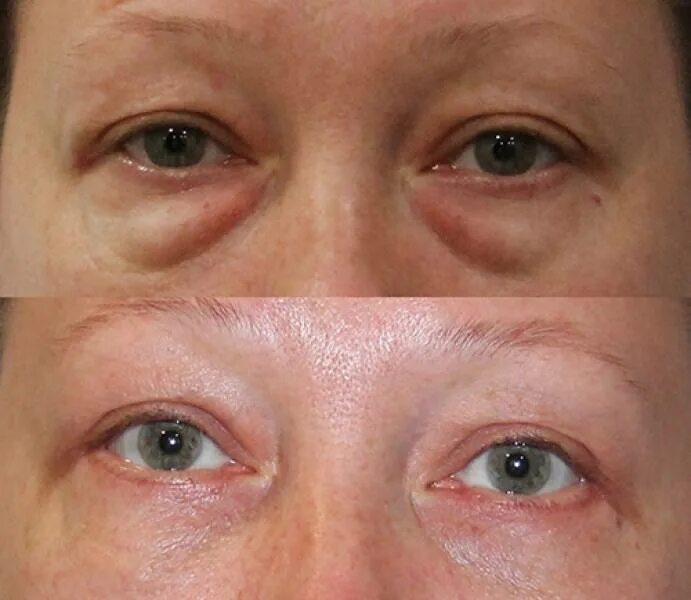 Мешки носослезной борозды. Эвисцерация глазного яблока операция. Удаление глаза как называется операция. Удаление глаза как называется операция. Трансконъюктивальная лазерная блефаропластика.