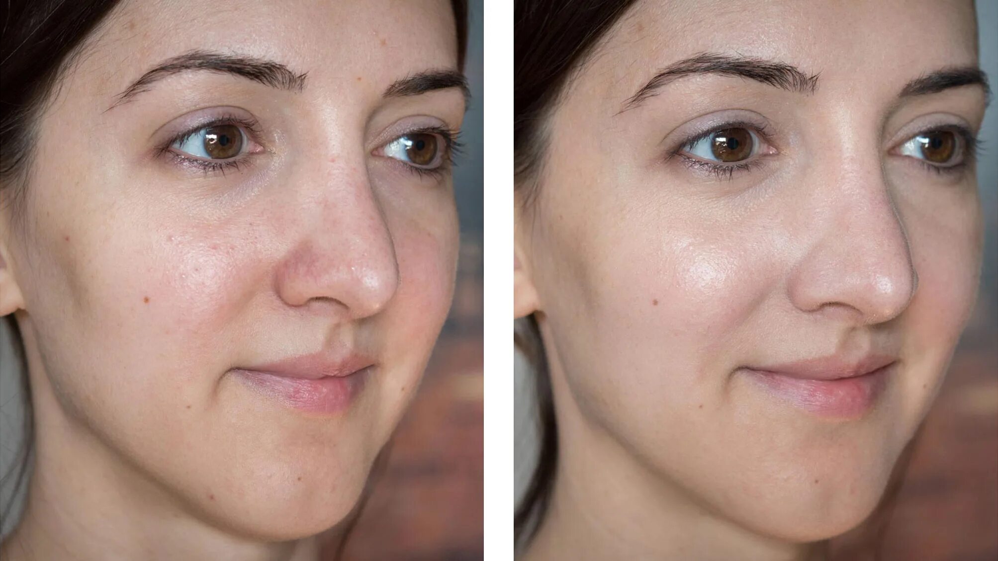 Как восстанавливается кожа. Химический пилинг до и после. Пилинг для лица.