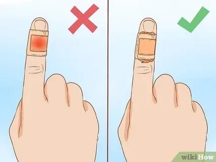Как наклеить пластырь