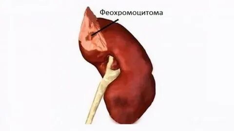 Рак надпочечников