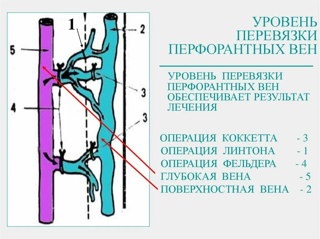 Перфорантные вены нижних конечностей. Клапанная недостаточность перфорантных вен нижних конечностей. Субфасциальная перевязка перфорантных вен. Сафено феморальное соустье вены УЗИ.