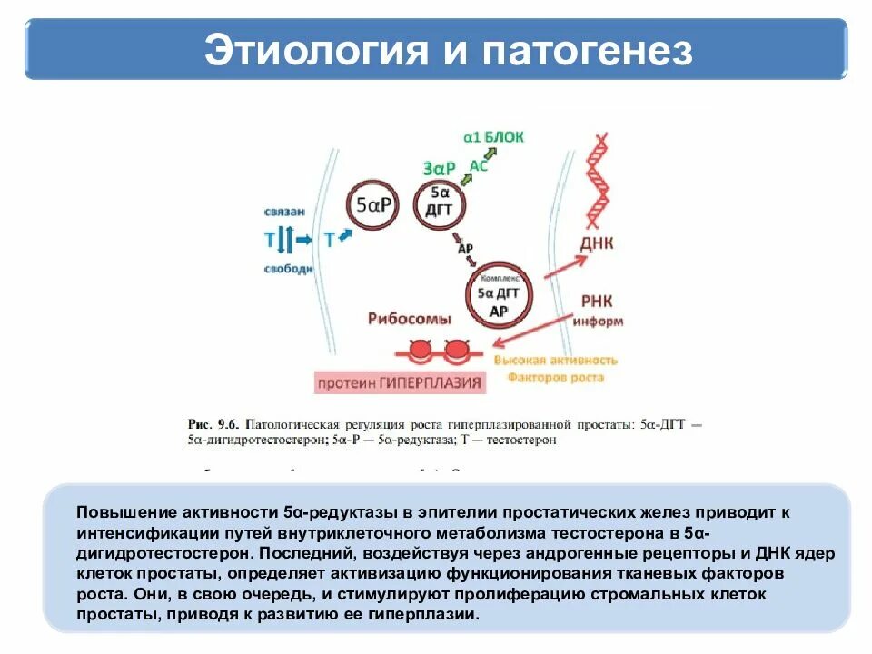 Химия простаты. Гиперплазия предстательной железы этиология. Аденома предстательной железы механизм развития. ДГПЖ этиология и патогенез. Патогенез аденомы предстательной железы.