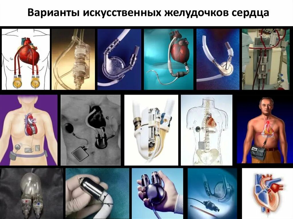 Искусственный левый желудочек. Искусственный желудочек сердца. Искусственный левый желудочек сердца. Искусственный левый желудочек операция.