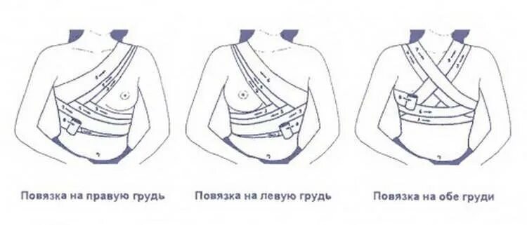 Повязка на молочные железы алгоритм. Наложение повязки на молочную железу алгоритм. Как перевязать грудные железы для прекращения лактации. Как перевязывать грудь для остановки лактации. Схема перевязки груди.