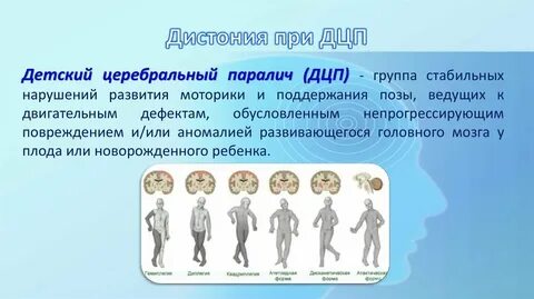 Почему возникает дцп