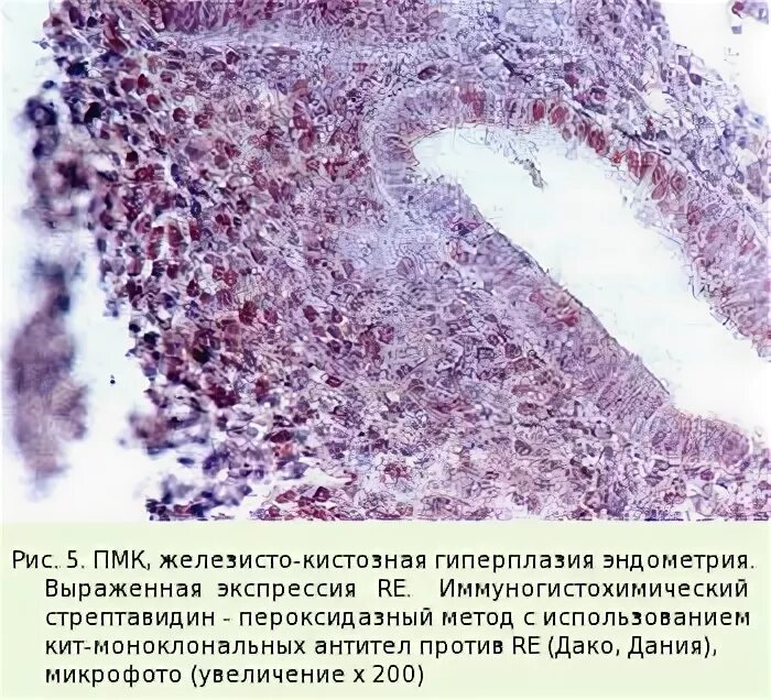 Гипопластического эндометрия. Гиперплазия матки гистология. Железисто-кистозная гиперплазия гистология. Гипопластический эндометрий гистология.