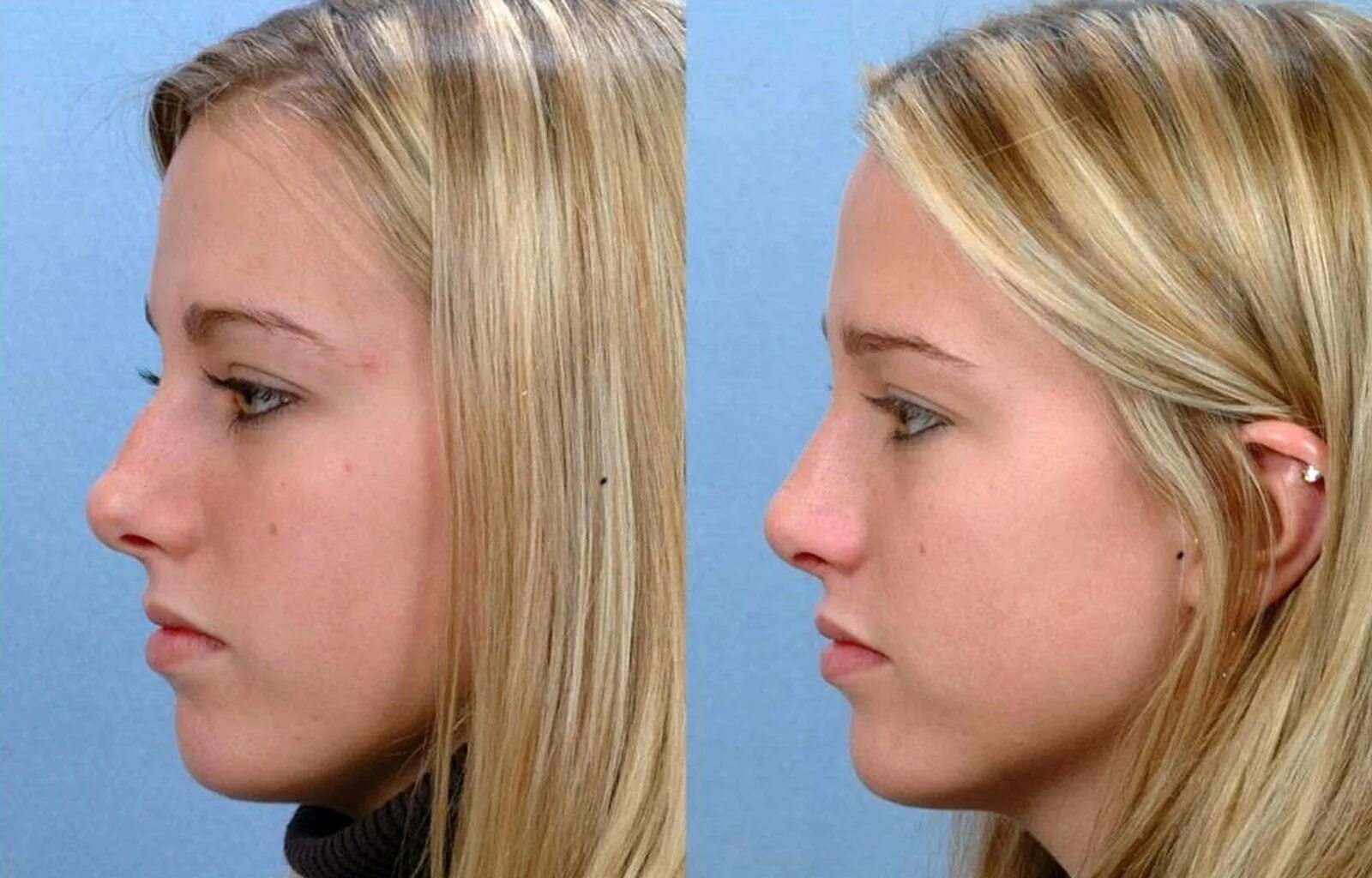 Ринопластика гюсан. Пластика носа. Rhinoplasty process. Со скольки можно делать ринопластику носа девушкам. Со скольки можно делать ринопластику носа девушкам.