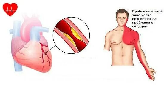 Как болит сердце. Сильные покалывание в сердце.