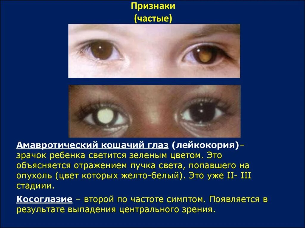 Зрачок кошачий глаз признак биологической. Симптом кошачьего зрачка. Симптом кошачьего глаза это признак.
