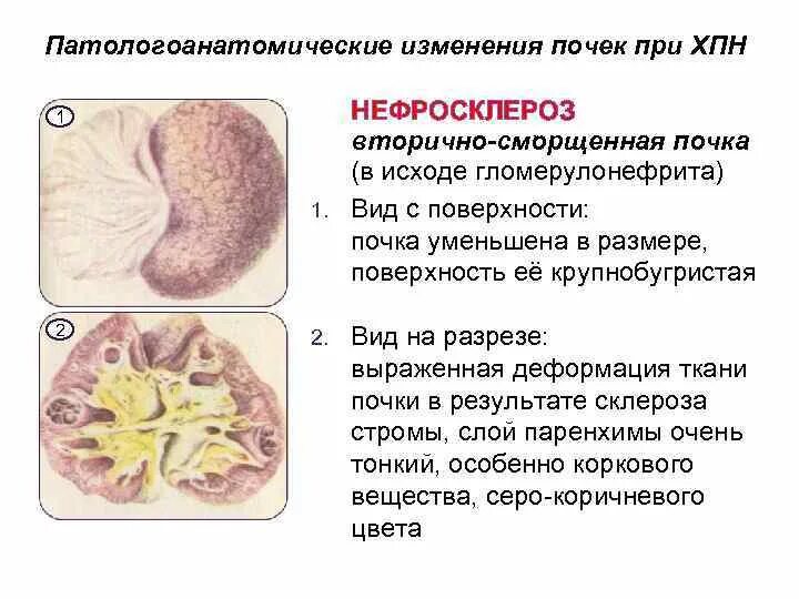 Нефросклероз почек на узи что это такое. Нефросклероз почек на узи что это такое