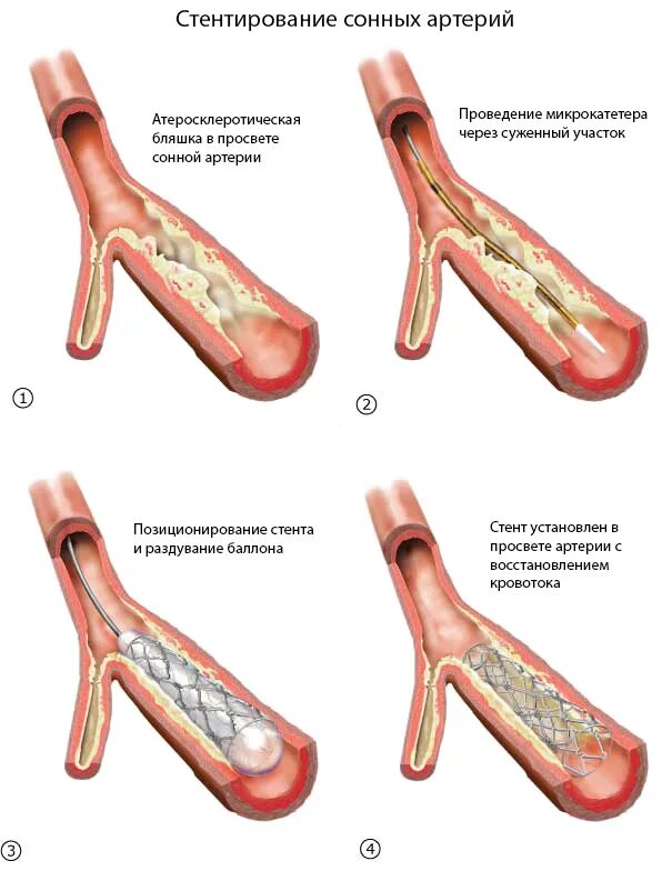 Операция при атеросклерозе сосудов. Стентирование шейных артерий. Операция сонной артерии бляшка. Ангиопластика сонной артерии. Атеросклероз стентирование.
