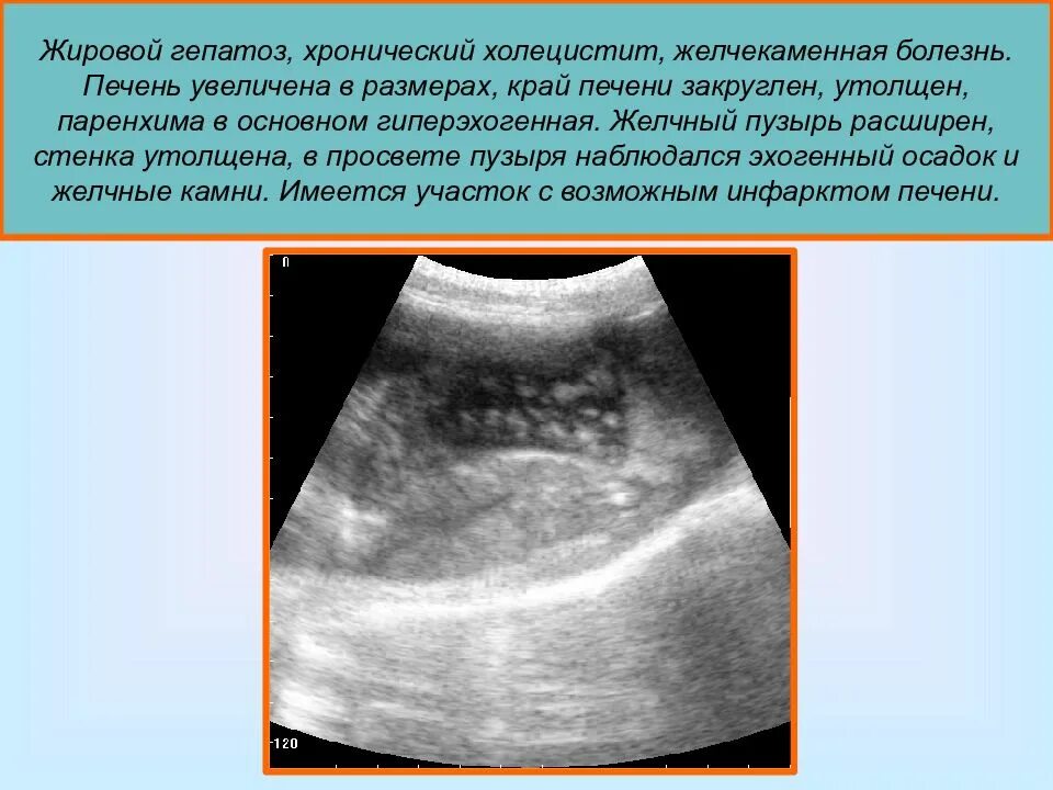 Эхогенный желчный пузырь. УЗИ признаки жирового гепатоза. Жировой гепатоз печени на УЗИ. Жировой стеатох на УЗИ.