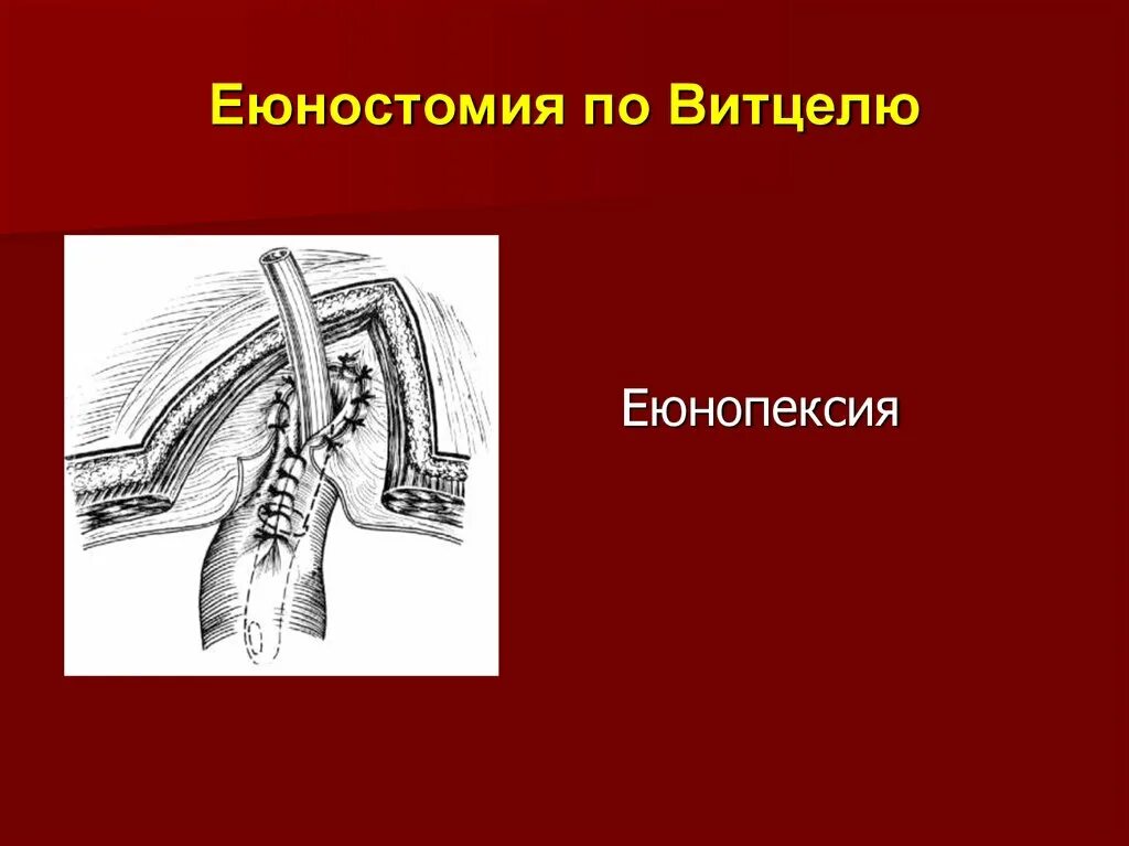 Еюностома это. Гастростома и еюностома. еюнгстома по айзельсбергу витцелю. еюностомия по витцелю техника.