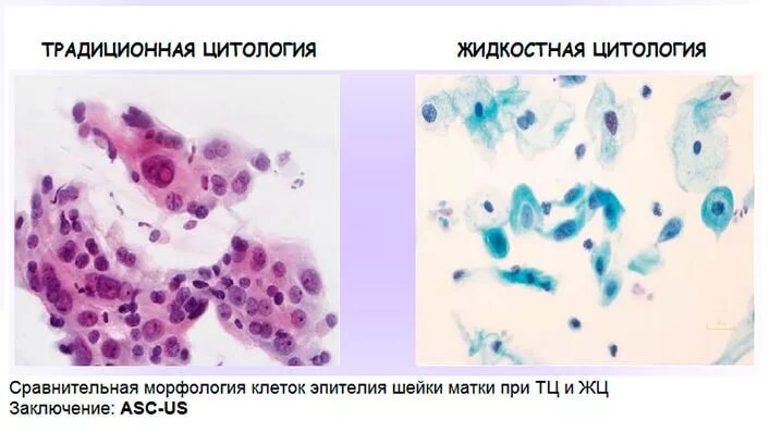 Методы цитологического исследования шейки матки. Цитологический метод и микроскопия. Цитологическое исследование цервикальных мазков. Цитологическое исследование микропрепарата шейки матки. Пап тест шейки