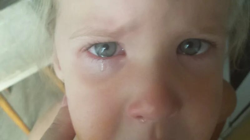 Спортивные травмы глаза. Попала пальцем в глаз болит. Попала пальцем в глаз болит. При химических ожогах глаз следует. Мужчина протирает глаза.