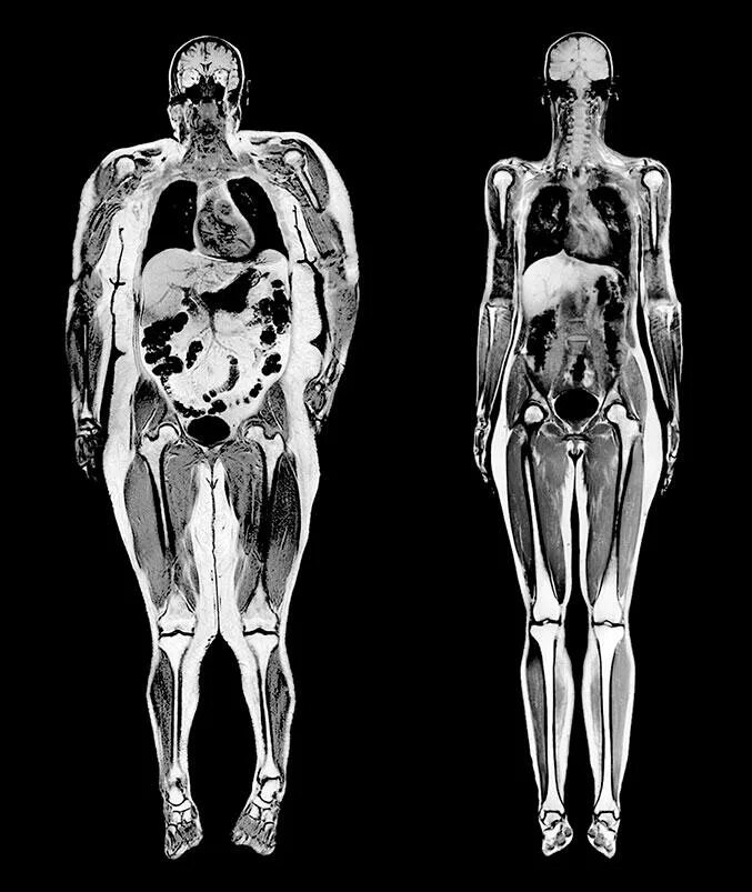 Скелет Толстого человека и худого рентген. Рентген тела. Реген Толстого человека. Мрт тела полное цена