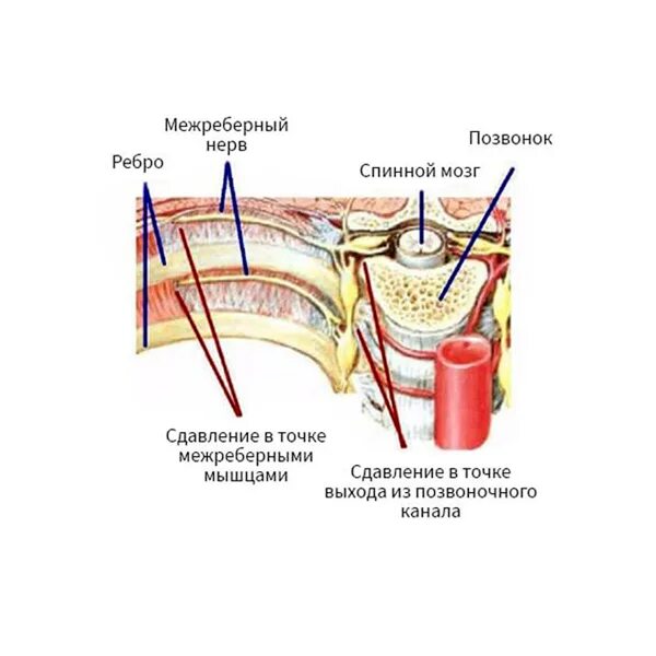 Межреберная невралгия симптомы. Межребкрная нкврвогия. Межреберная невралоги. Невралгии межреберных нервов. Чем снять межреберную невралгию