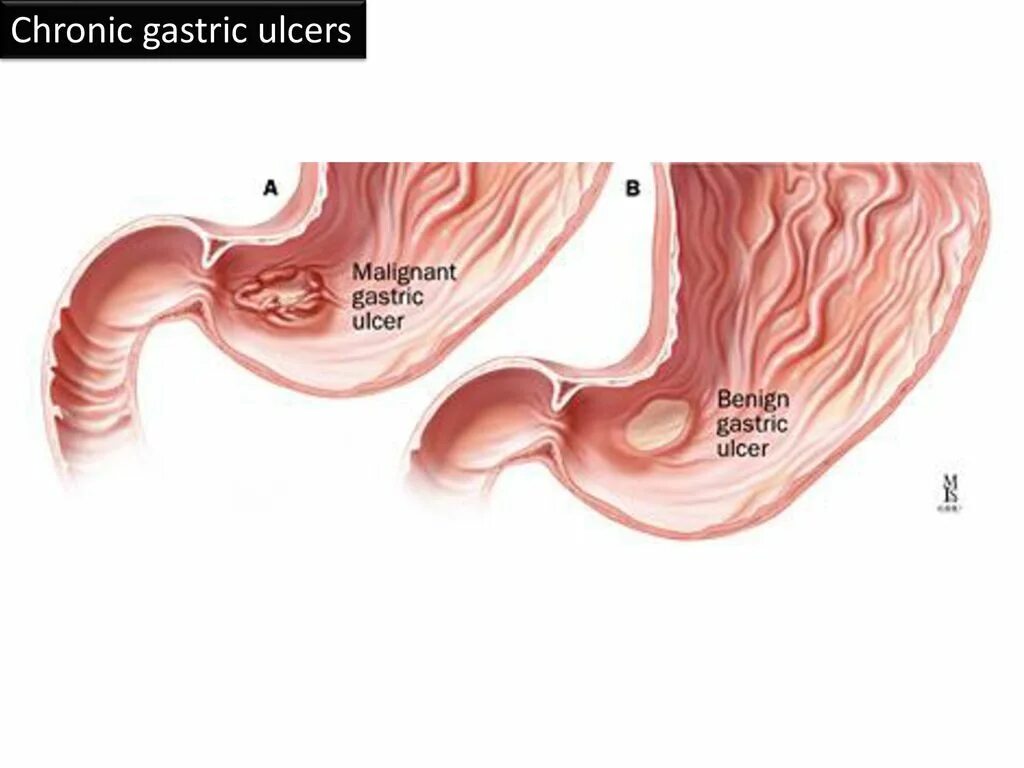 Малигнизация язвы желудка. Малигнизация язвенной болезни желудка. Малигнизация язв 12 перстной. Малигнизация осложнения язвы желудка двенадцатиперстной кишки. Осложнения желудка 12 перстной кишки