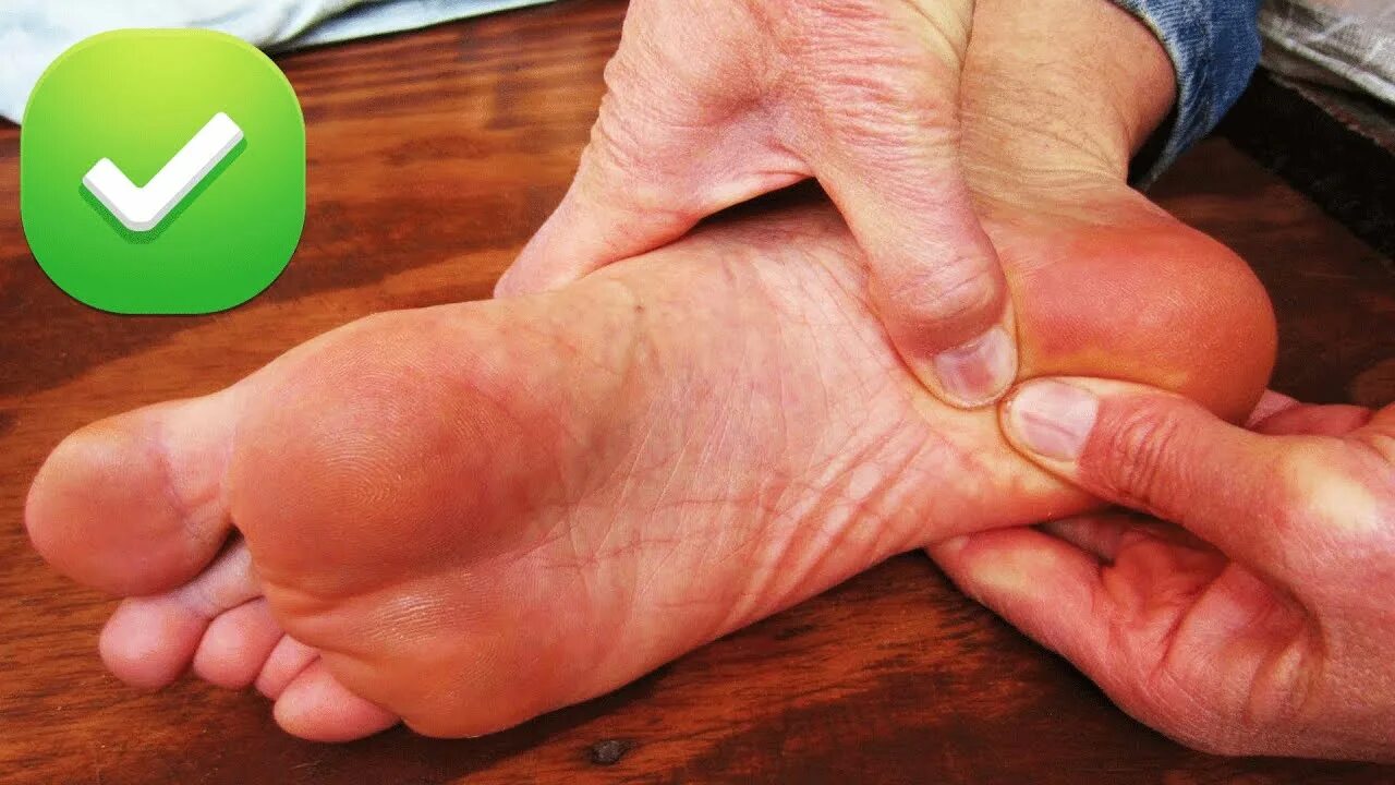 Болезнь хаглунда-шинца. Косточка на внутренней стороне стопы. Натер сбоку. Костная мозоль на лодыжке. Болезно хоглунда шпица.