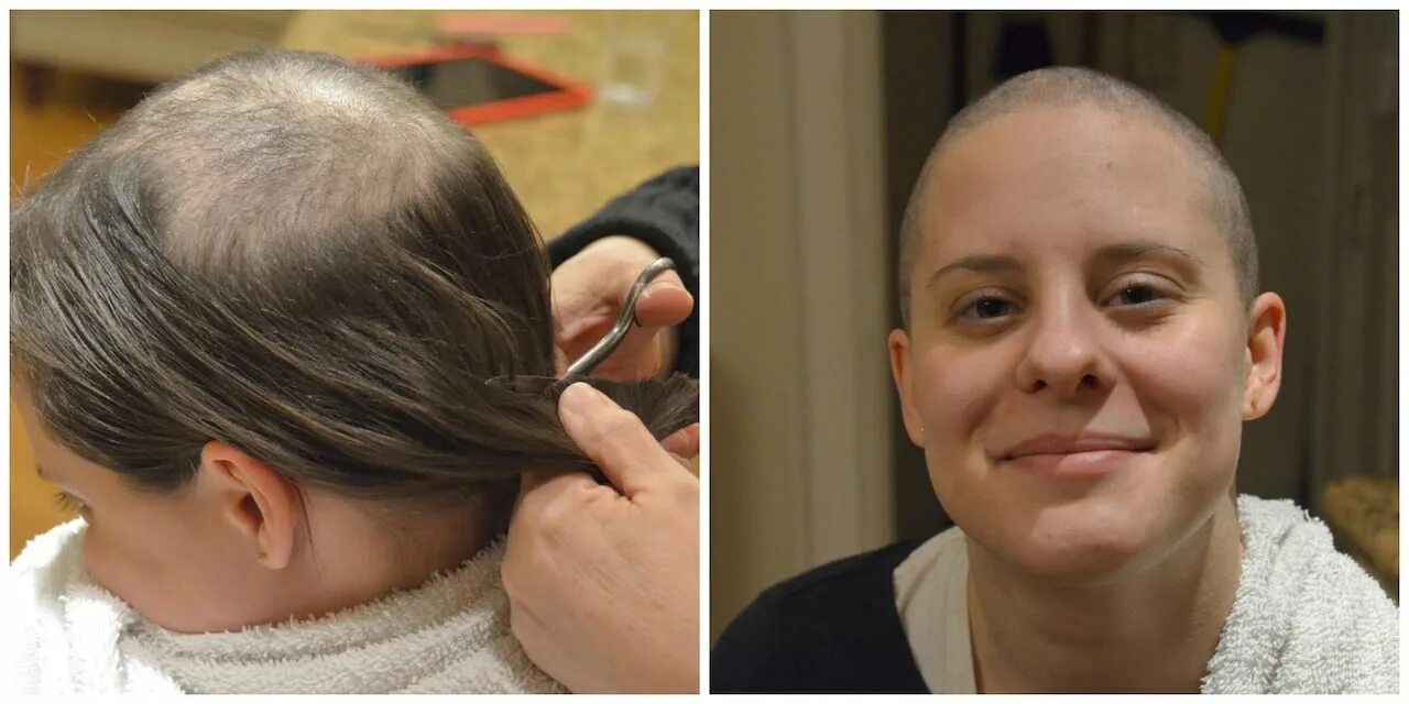 Какие волосы после химиотерапии. Волосы после химиотерапии. Стрижка для поредевших волос. Вырывание волос на голове.