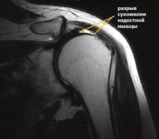 Разрывы отрыва. Разрыв сухожилия надостной мышцы плечевого сустава мрт. Ротаторная манжета плечевого сустава мрт. Разрыв вращательной манжеты плечевого сустава рентген. Разрыв вращательной манжеты плечевого сустава мрт.