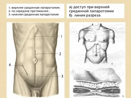Экстренная лапаротомия