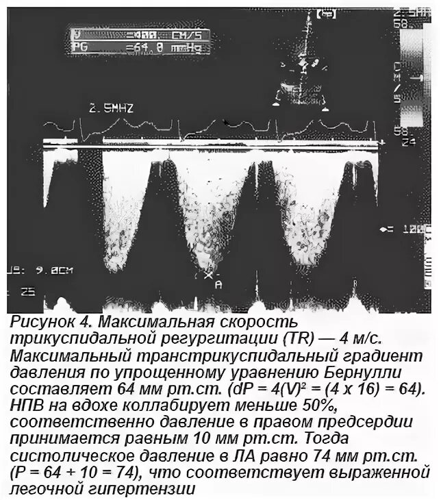 Определение степени трикуспидальной регургитации. Недостаточность клапана легочной артерии на узи. Недостаточность трикуспидального клапана эхокг. Регургитация на аортальном клапане классификация. Аортальная регургитация по pht.