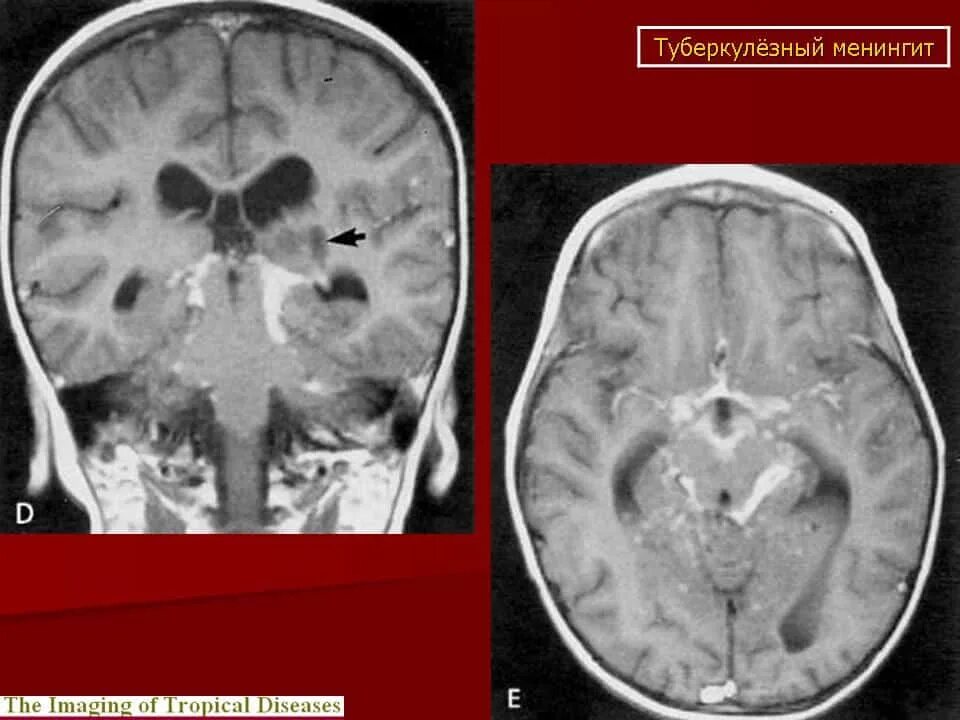 Туберкулезный менингоэнцефалит. Туберкулезный менингоэнцефалит кт. Базилярный туберкулезный менингит. Туберкулез мозговых оболочек мрт.