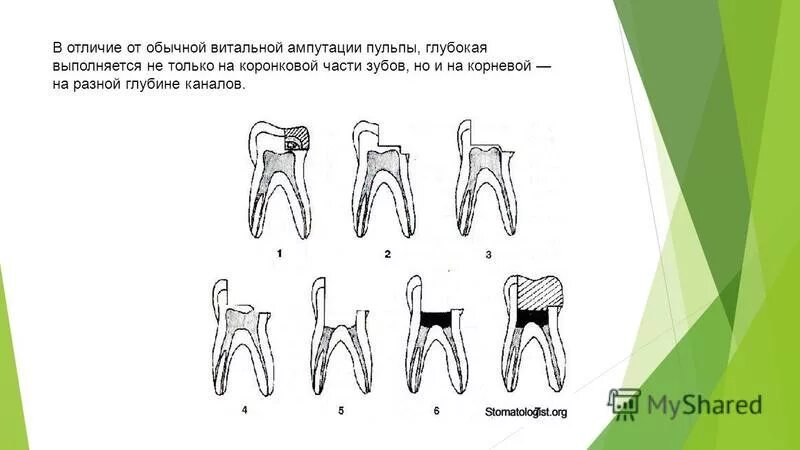 Девитальная ампутация и витальная ампутация. Пульпотомия ампутация корневой пульпы. Витальная ампутация коронковой пульпы. Витальная ампутация пульпы схема.