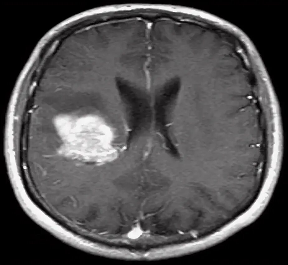 Опухоль мозга у собак. Опухоль головного мозга на зрительном Бугре. Опухоль головного мозга с куриное яйцо.