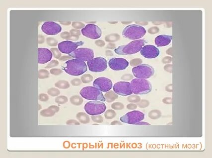 Острый плазмоклеточный лейкоз