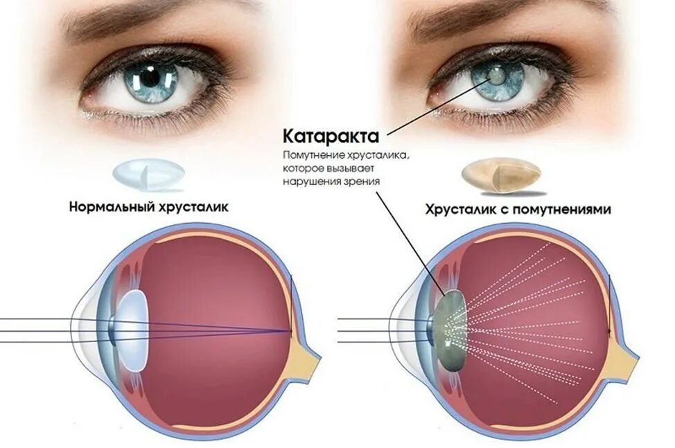 Катаракта – помутнение хрусталика глаза.. Катаракта схема глаза. Катаракта хрусталик строение. Катаракта глаза катаракта схема. Пропадает зрение на одном глазу
