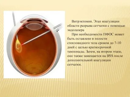 Витрэктомия