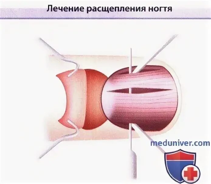 Мембранопролиферативный гломерулонефрит. Повреждение матрикса ногтевой пластины. Расщепление матрикса. Атеросклероз степень и стадия развития. Атф-синтетаза митохондрии.