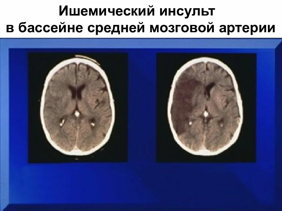 Инсульт в бассейне мозговой артерии