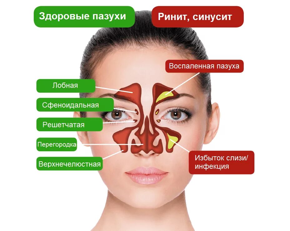 Что такое фронтит