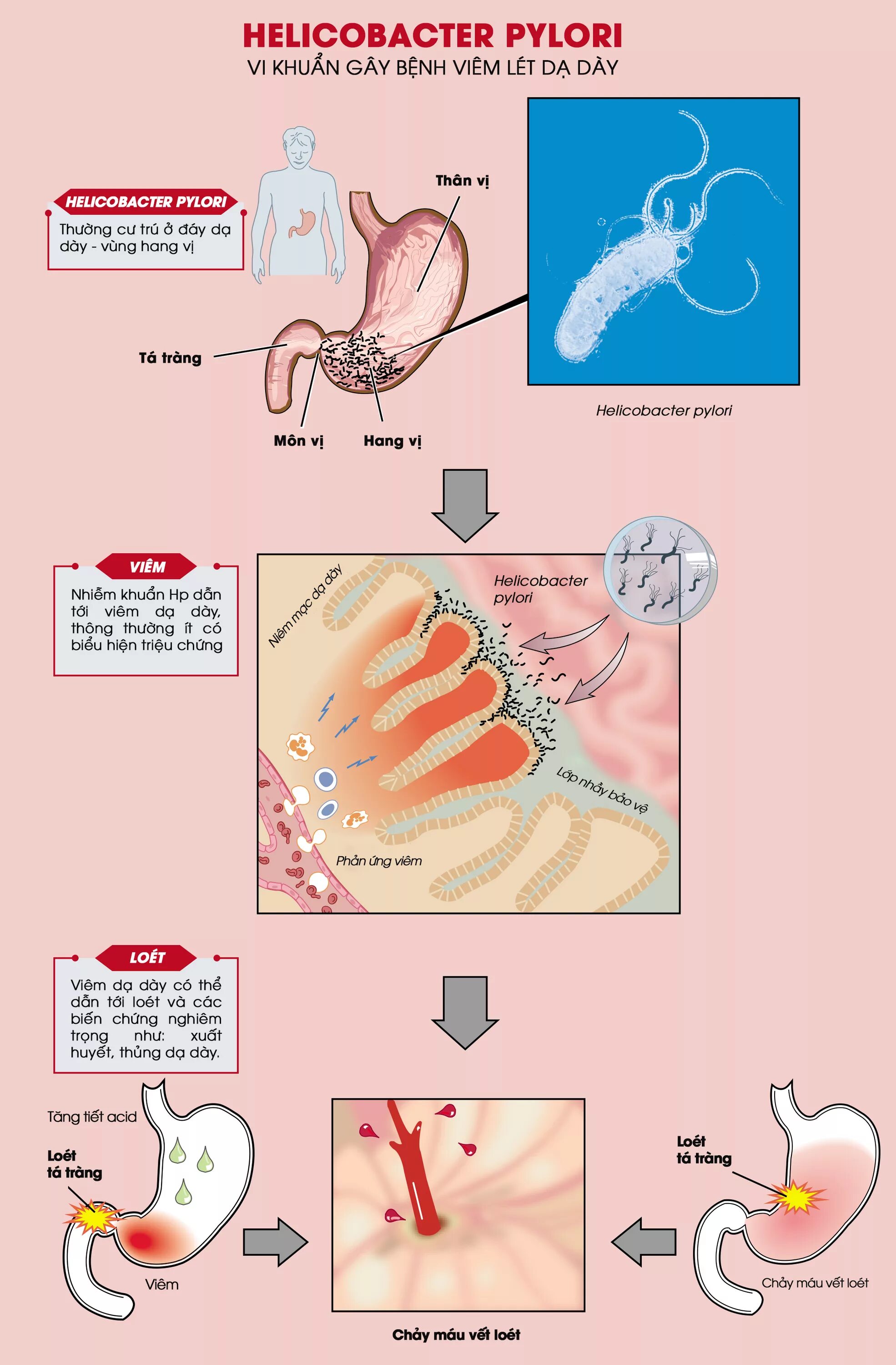 B helicobacter pylori. Бактерии хеликобактер пилори (helicobacter pylori). Хеликобактер пилори систематика. Хеликобактер пилори спиралевидные бактерии. Хеликтеробактерипилори что это.