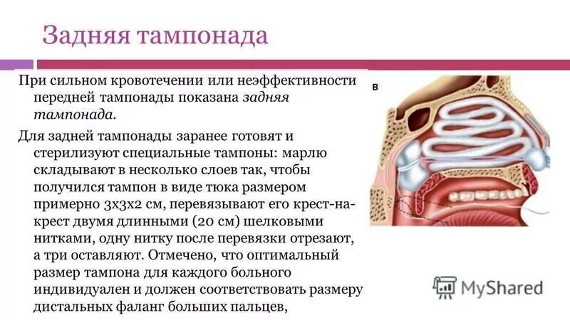 Передняя тампонада при носовом кровотечении. Передняя тампонада носовых ходов при носовом кровотечении. Задняя тампонада при носовом кровотечении алгоритм. Передняя и задняя тампонада при носовом кровотечении алгоритм. Задняя тампонада полости носа.