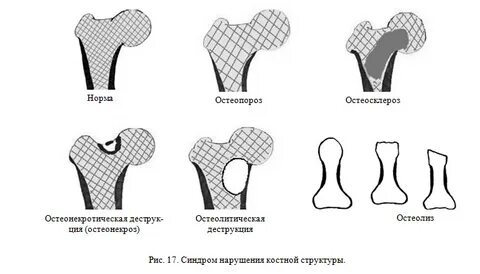 Изменения костной структуры