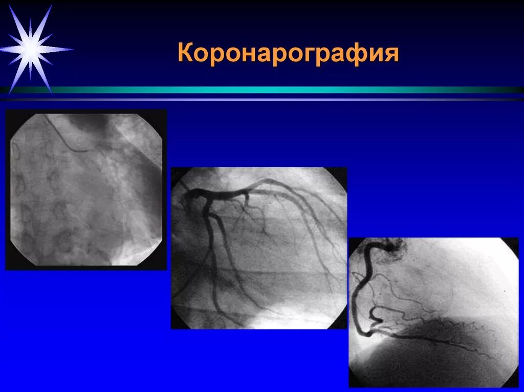 Коронарография через лучевую артерию. Коронарная ангиография (коронарография). Селективная коронарография. Селективная коронарная ангиография.
