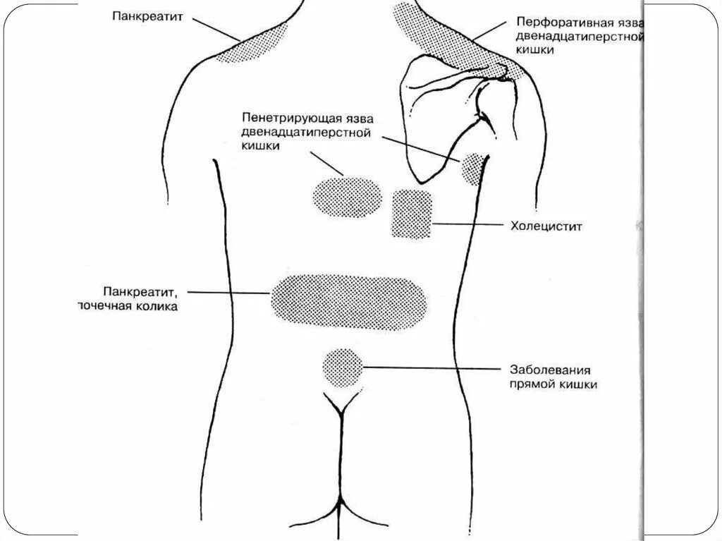 Локализация панкреатита. Язва желудка локализация боли. Локализация боли при язвенной болезни. Хронический панкреатит локализация боли. Локализация боли при заболеваниях ЖКТ.