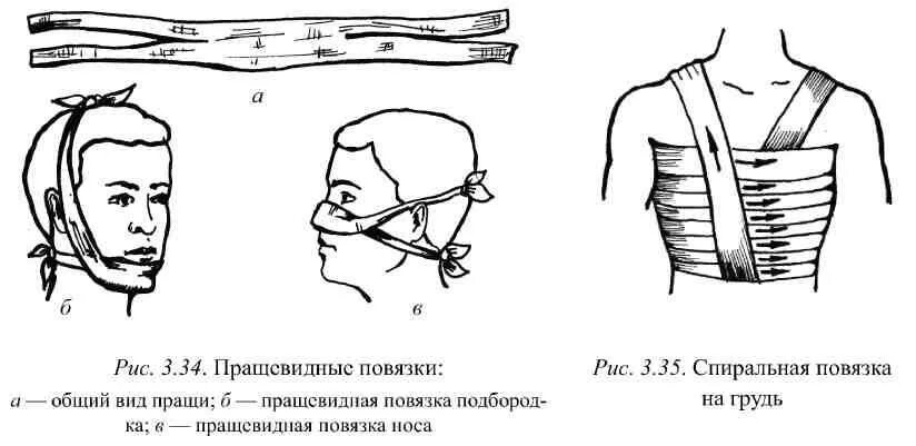 Техника наложения пращевидной повязки